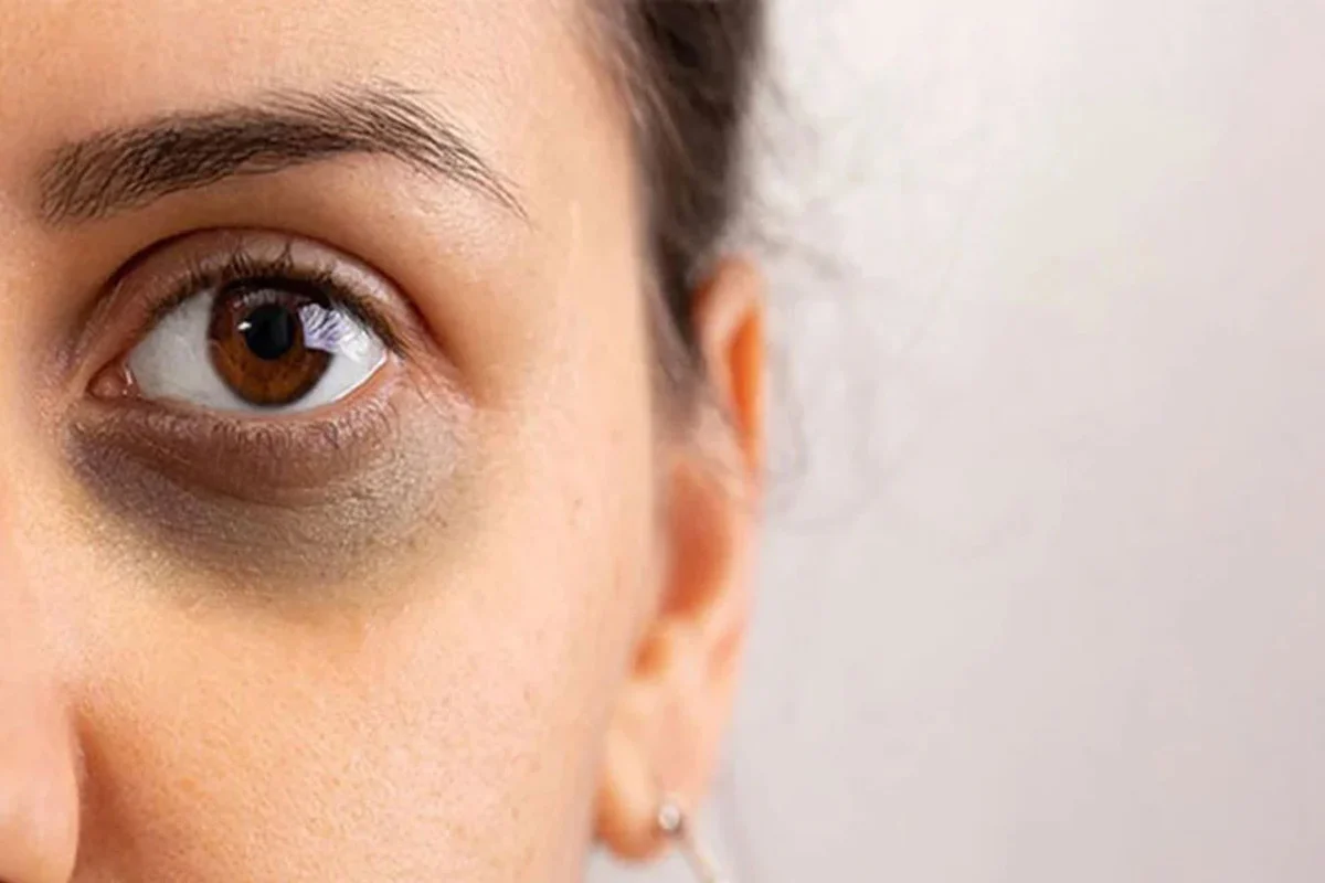 চোখের নিচে কালো দাগ; এর প্রতিকার